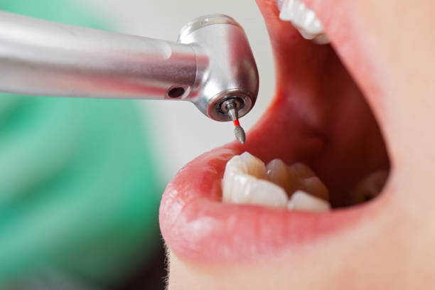 Best Emergency Wisdom Teeth Removal in Greenville, RI